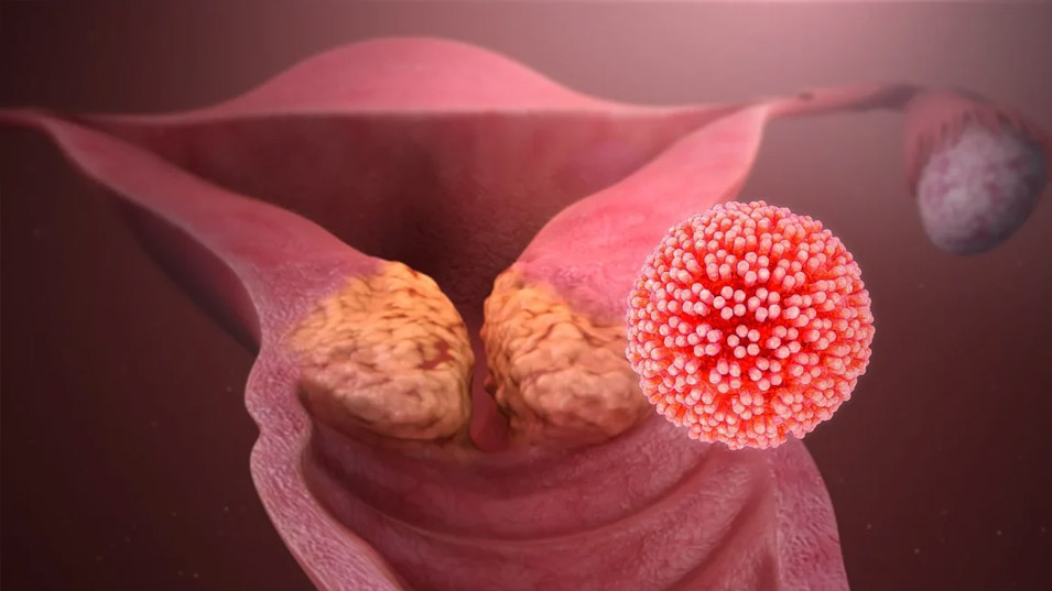 hpv